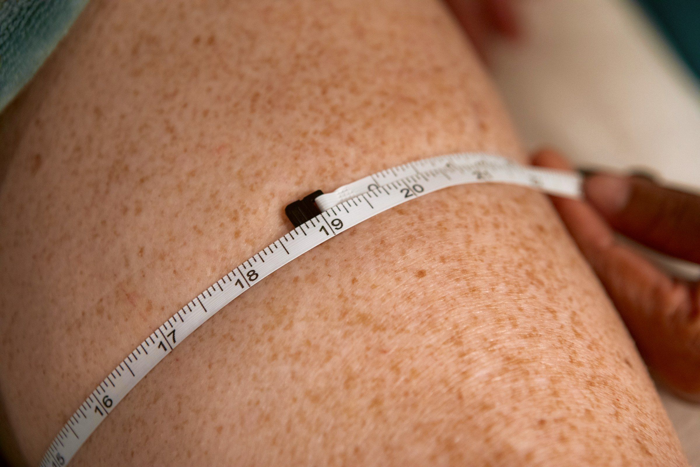Tape measure around the thigh after lymphatic drainage, reading 18 3/4 inches