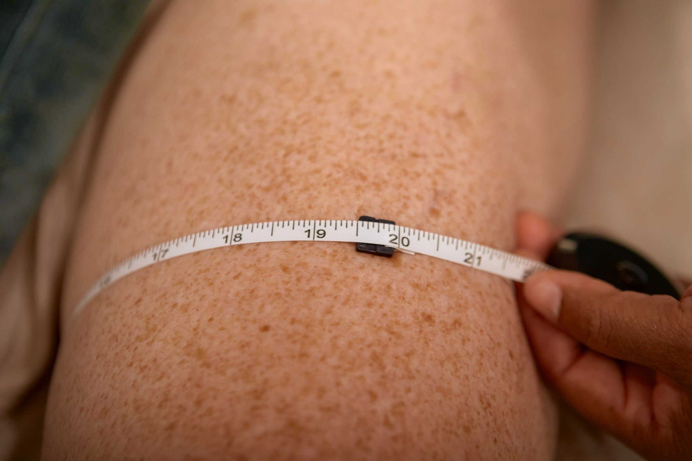 Tape measure around the thigh before lymphatic drainage, reading 19 1/2 inches